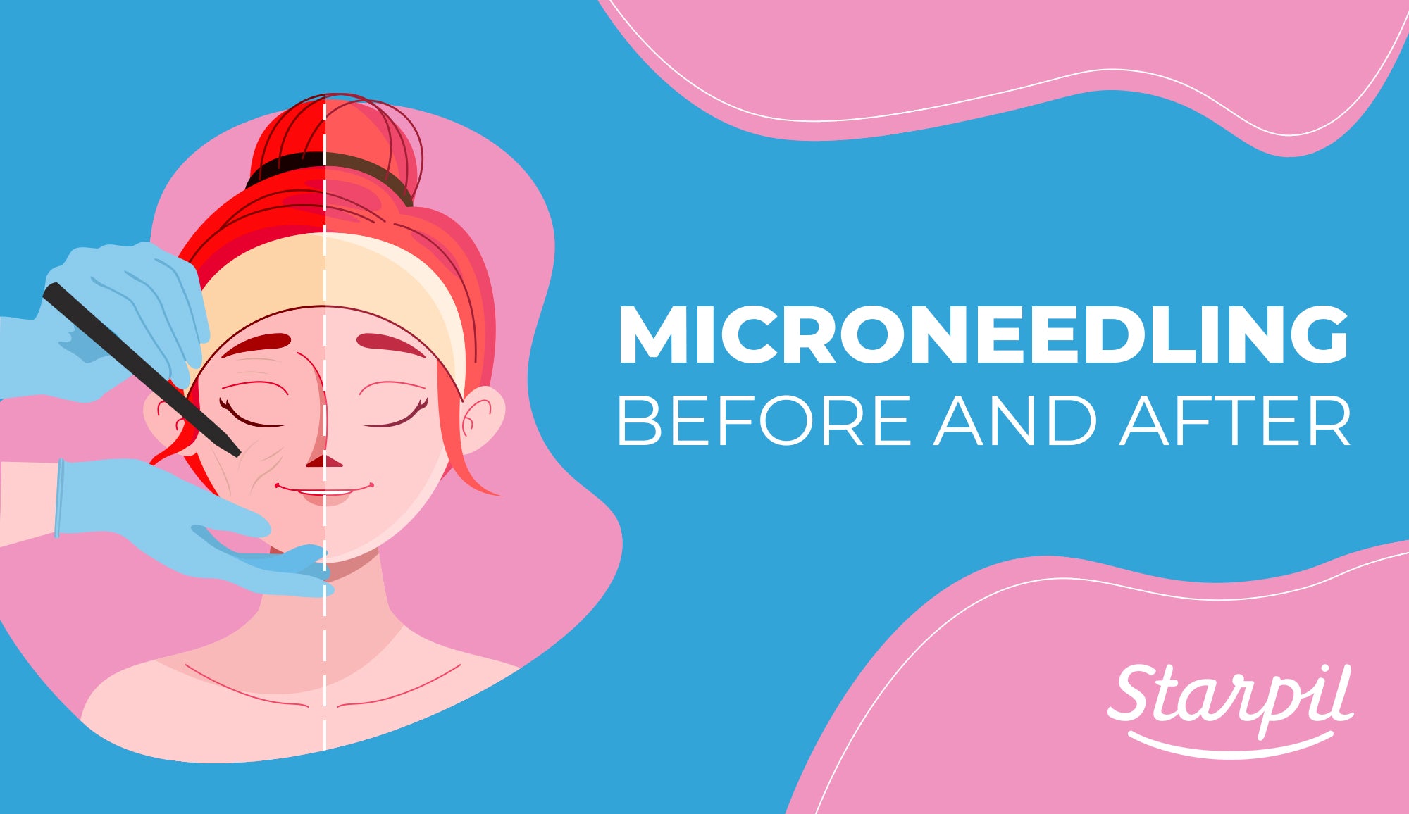 Microneedling - Before and After