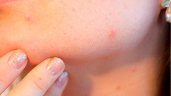 5 Simple Tricks to Avoid ‘Popping Pimples’ Post Waxing Sessions