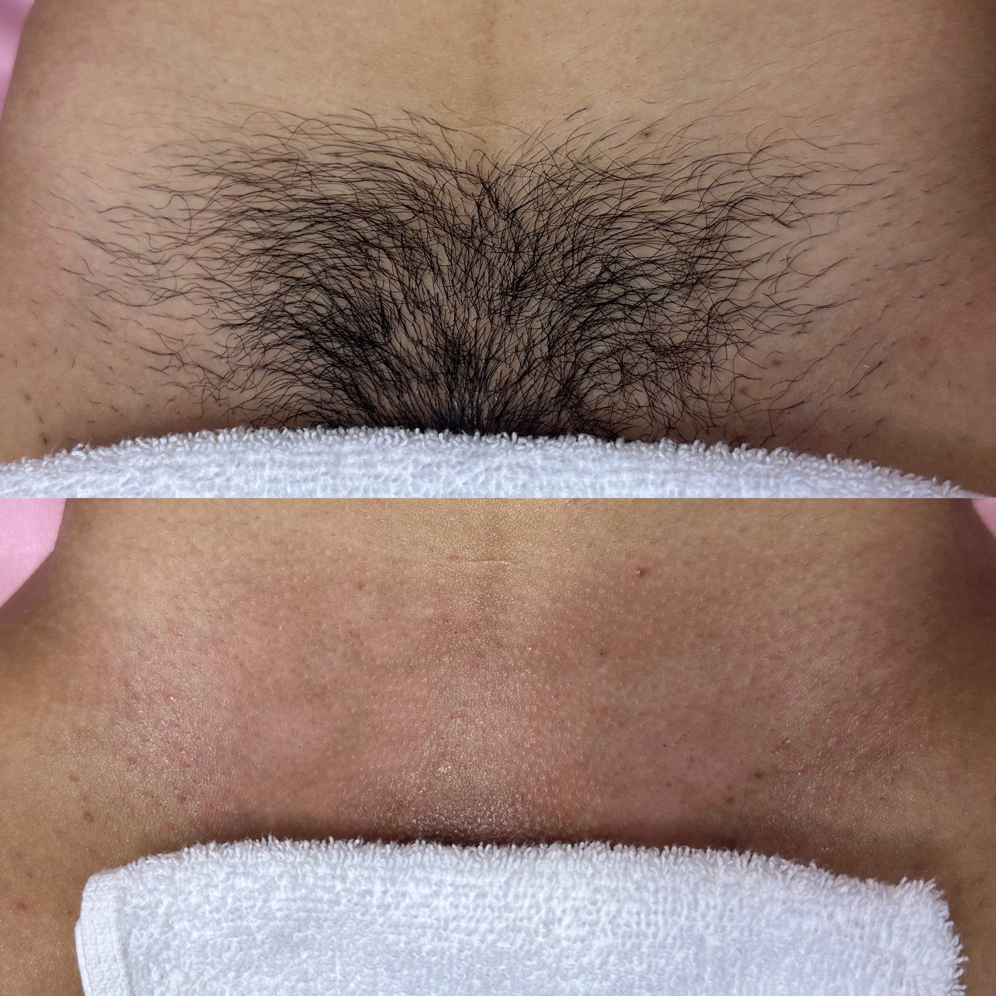 Brazilian before and after, deeper skin tone