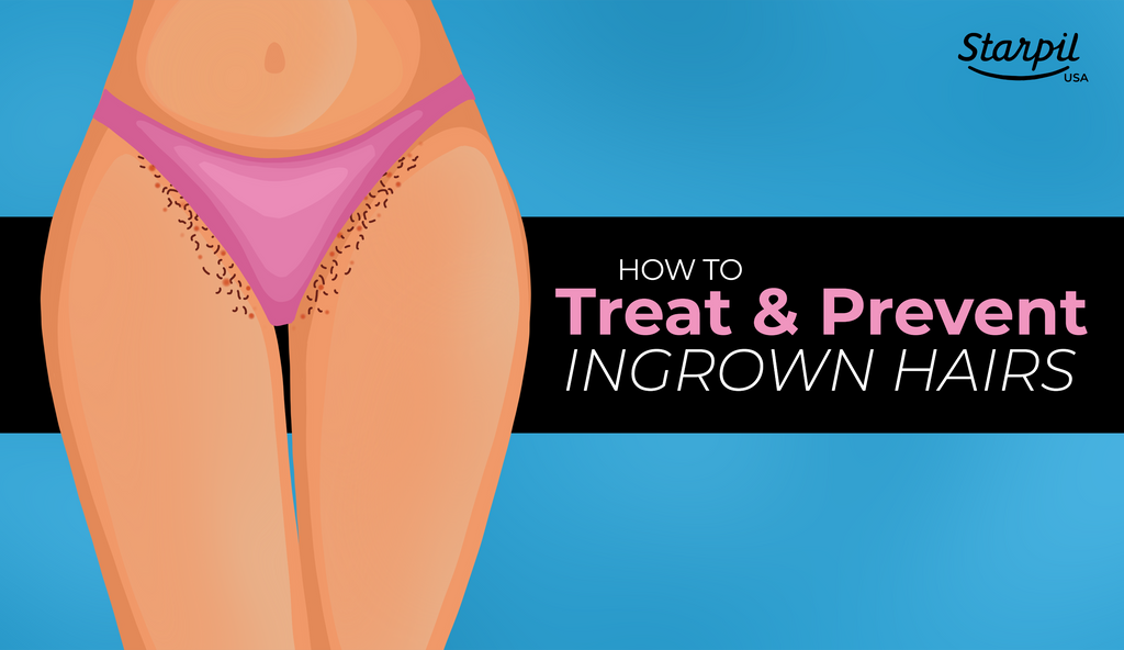 How to Prevent and Treat Ingrown Hairs After Waxing 