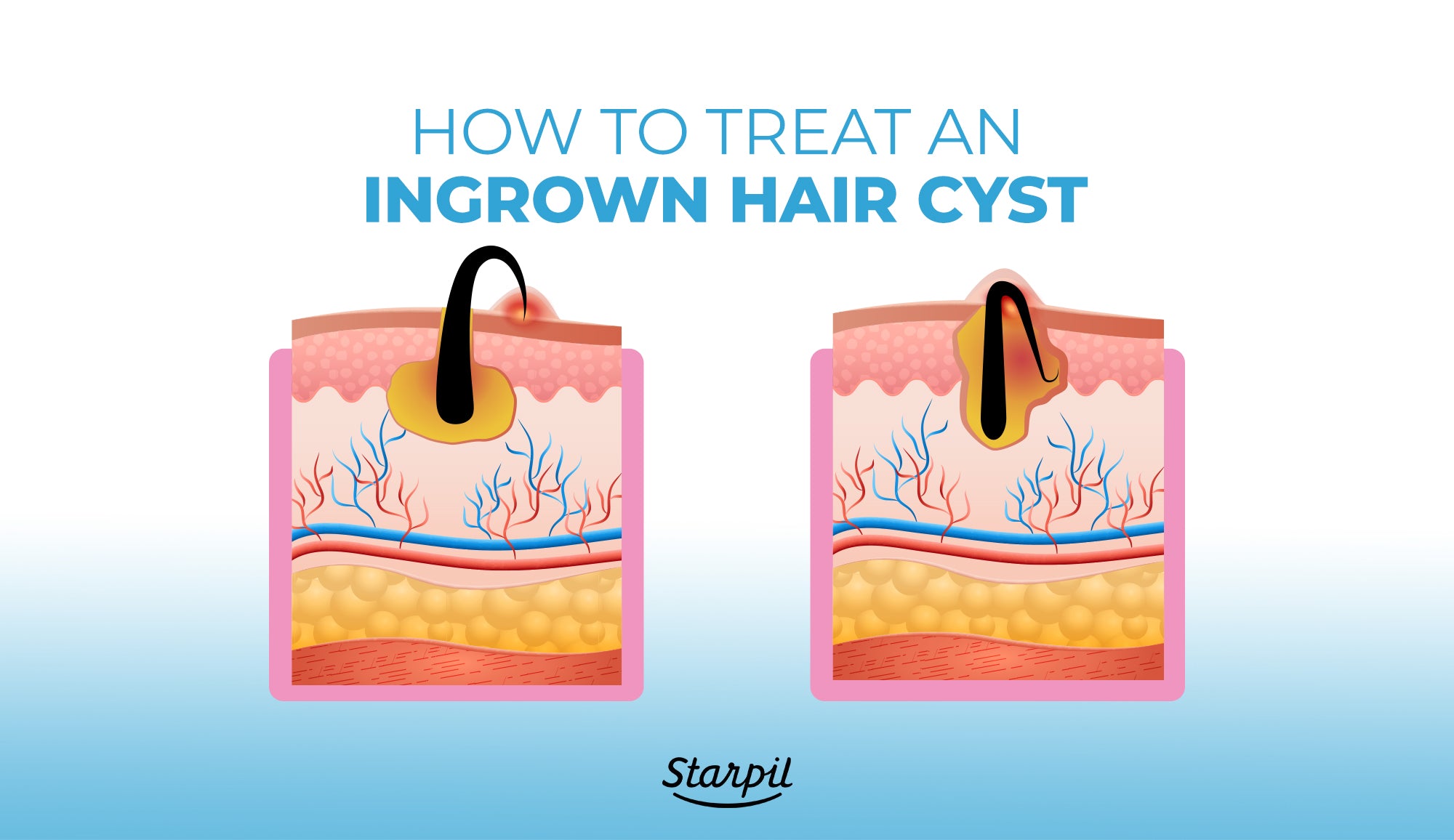 Ingrown Hair Cysts: Treatments, Causes & Symptoms