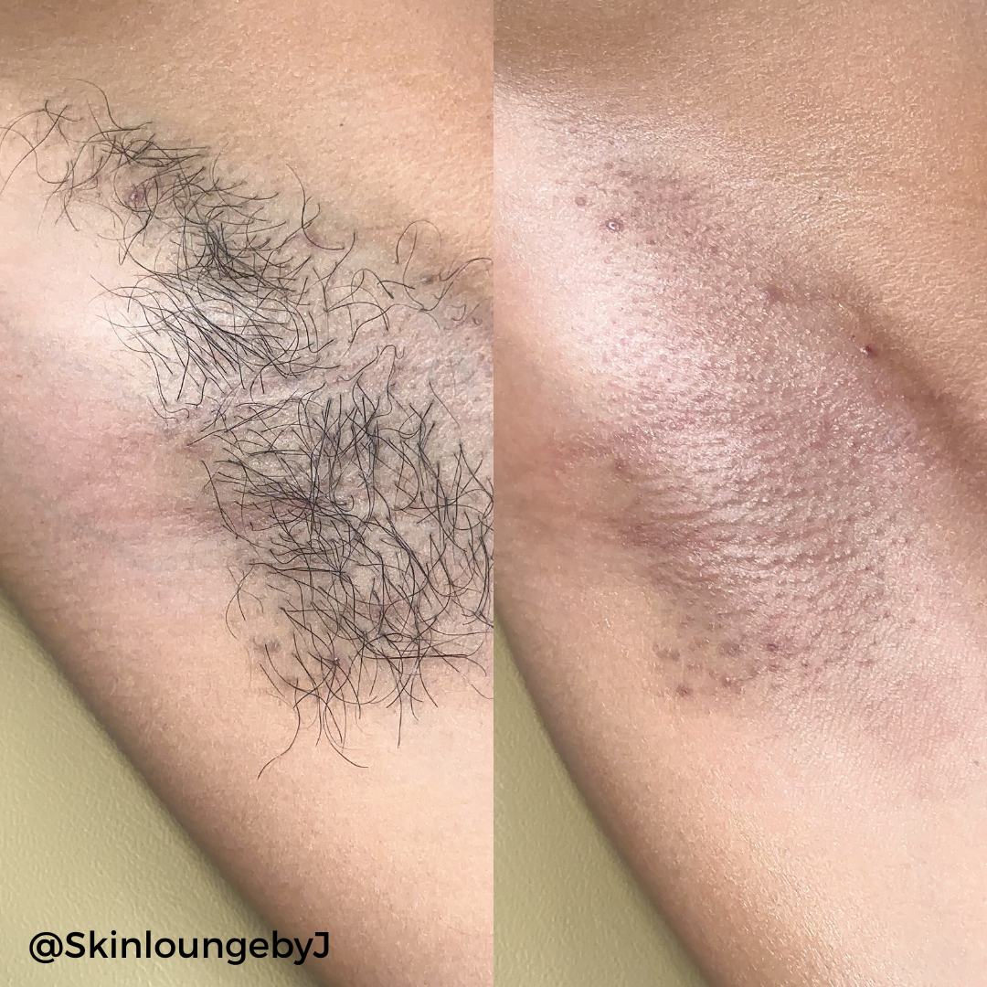 Kit de cera dura estándar