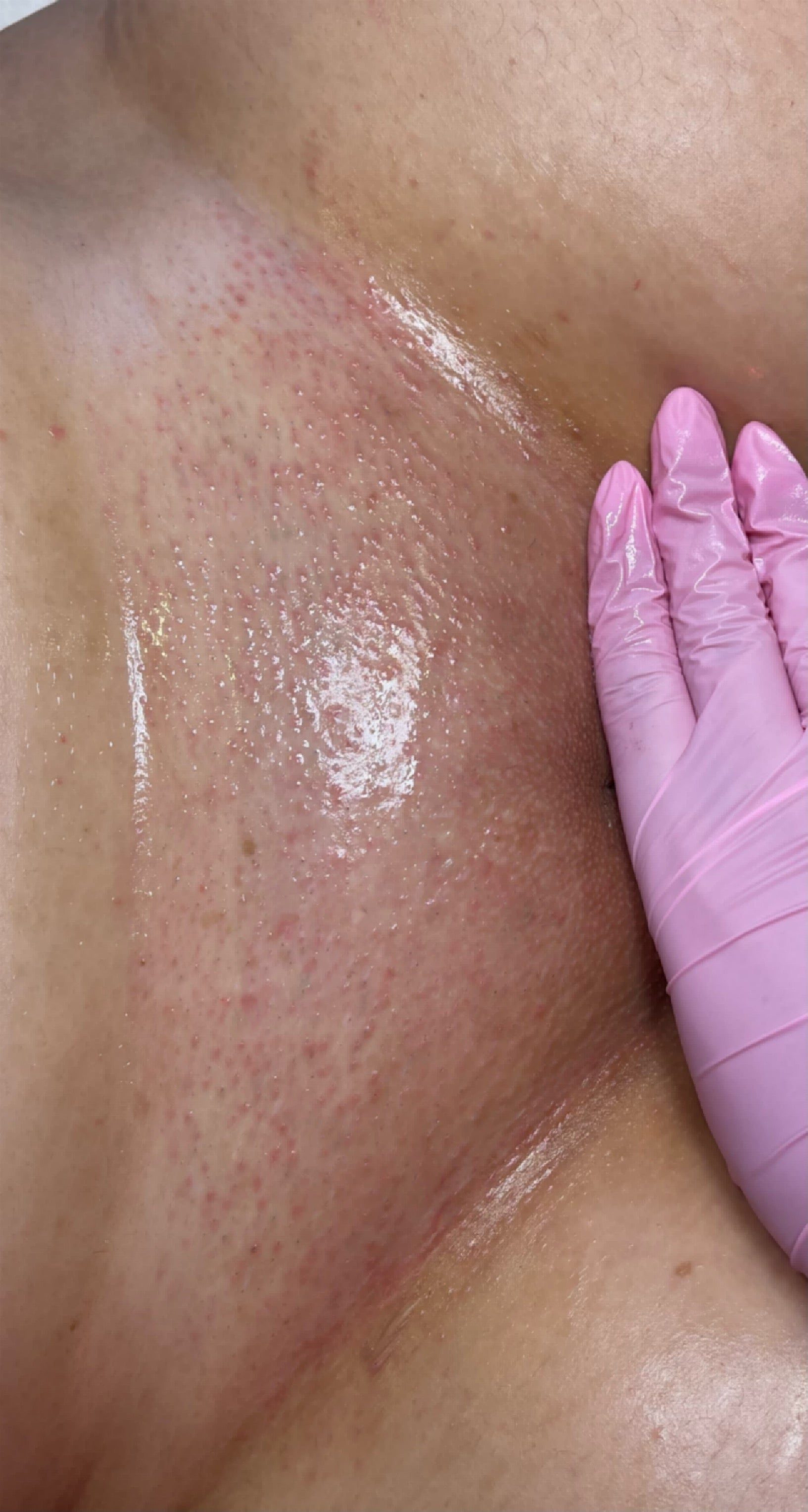 Calm, smooth skin after the mask has been peeled off